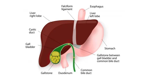 what is gallbladder stone?
